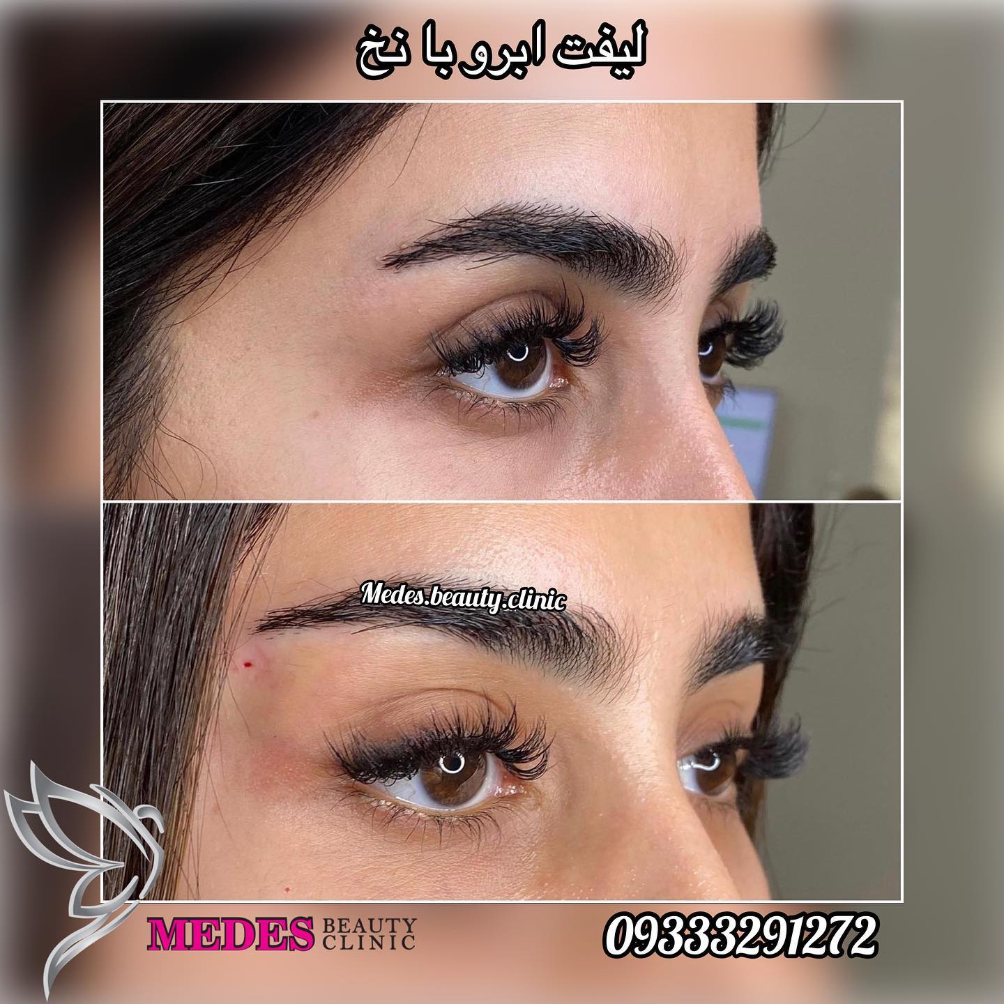 گالری لیفت با نخ